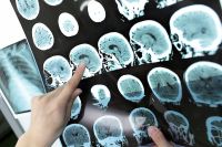 Nuevo avance en la detección temprana del Alzheimer 